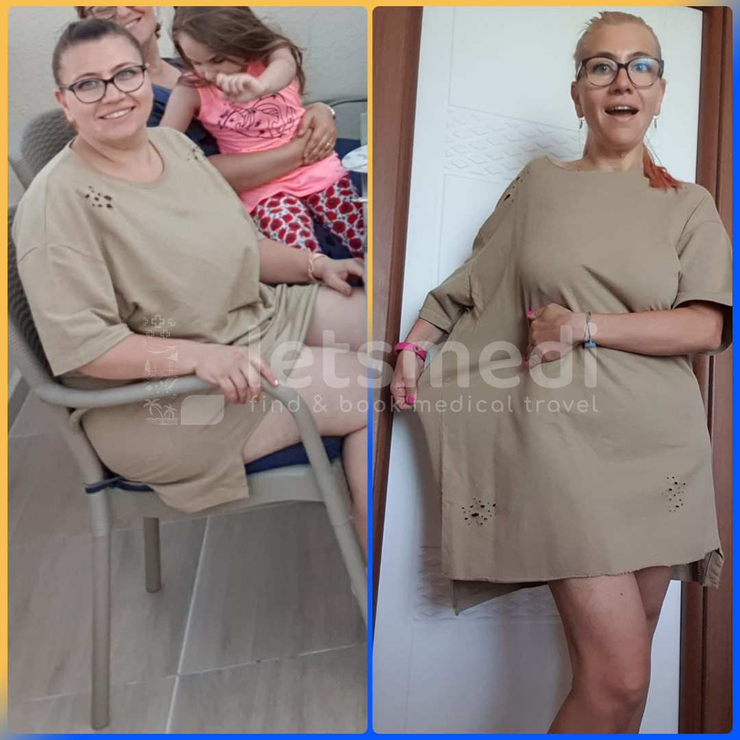 Before and after gastric sleeve in Turkey